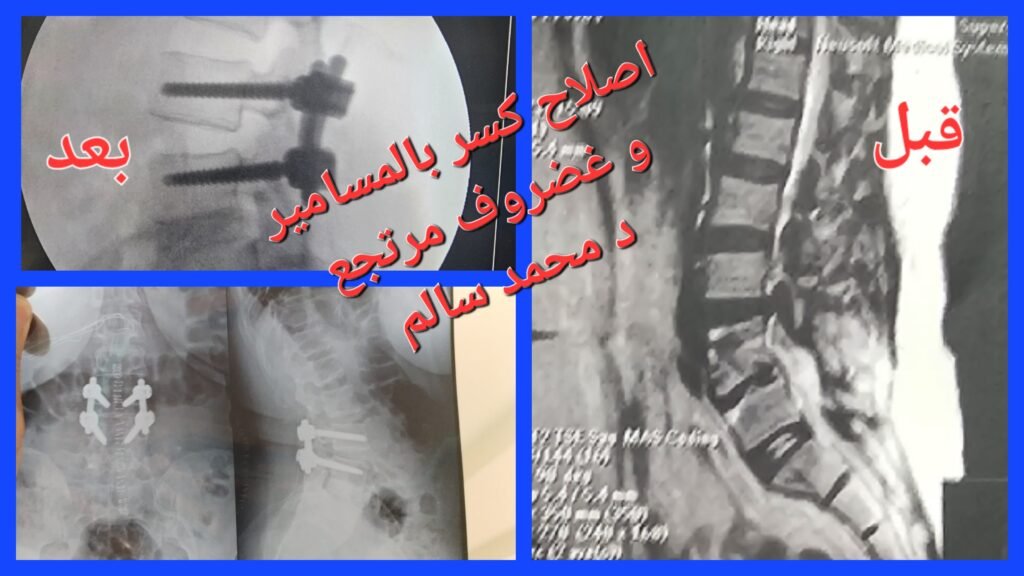 أفضل دكتور مخ وأعصاب في شبين الكوم | رأي حقيقي عن عيادة د. محمد سالم استشاري جراحة العمود الفقري